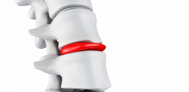 Herniated or Bulging Disk Causing Pain Herniated or Bulging Disk Causing Pain