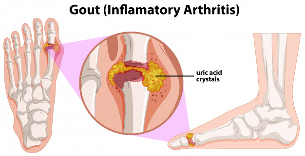Arthritis Stenosis Pain Relief Arthritis Stenosis Pain Relief